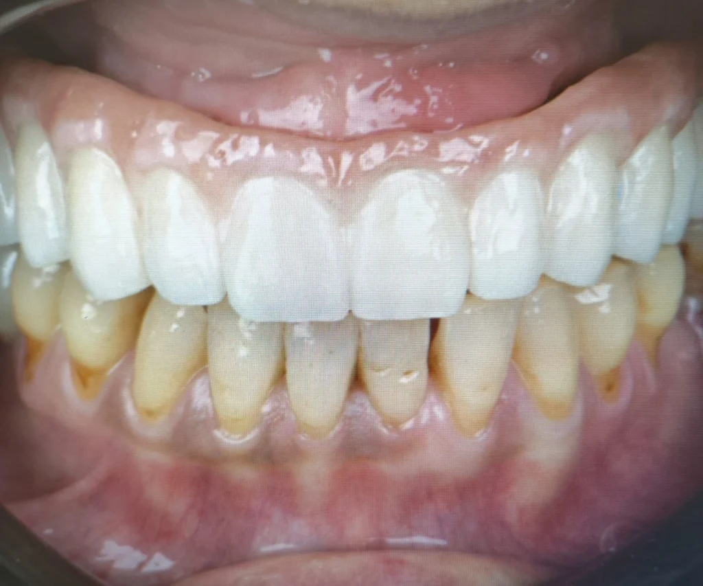 laboratoire dentaire dentotech bethune Prothèse adjointe Laboratoire dentaire DENTOTECH à Béthune