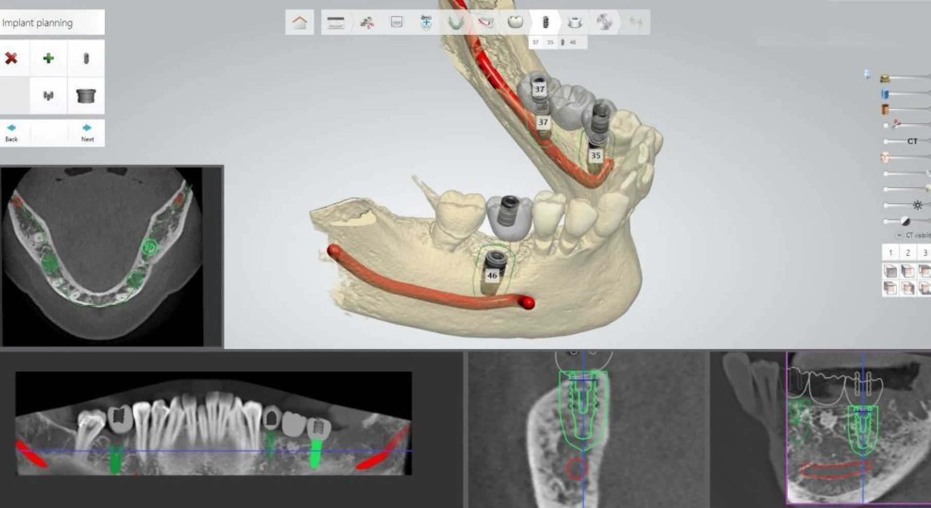 modelisation dentaire laboratoire dentotech bethune